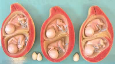 双胎妊娠模型