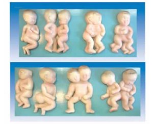 胎儿畸形模型